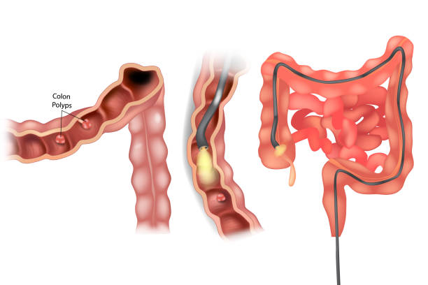 Best Doctor Colitis And Colonoscopy in Thane